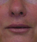 Face and Brow Lift and Eyelid Surgery 149153