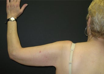 Arm Lift after 106148