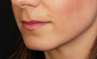 Lip augmentation before 393215
