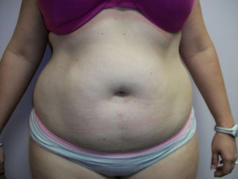 Liposuction before 258664