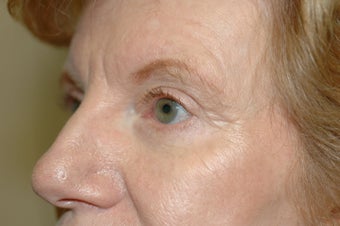Cheek augmentation with cheek lift, ptosis repair, and elimination of festoons 341472