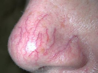 Vein treatment before 135904