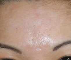 Before and After Acne Scar Treatment with Subcision and cO2 Laser Resurfacing after 562085