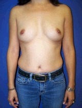 Breast Augmentation before 418008