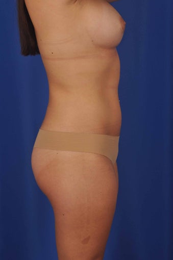 56 Year-Old Woman with Bilateral Breast Reconstruction 647197