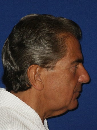 Facelift, Endoscopic Browlift, Upper and Lower Blepharoplasty with canthopexy before 249293