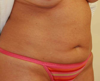 Abdominoplasty (Tummy Tuck) before 216683