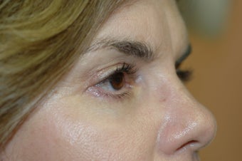 Midface lift, upper and lower eyelid surgery, Hetter resurfacing chemical peel after 433480