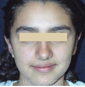 Otoplasty (ear set-back) after 147638