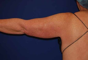 Liposuction Upper Arm before 513399