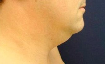 Male Neck Lipo before 374874