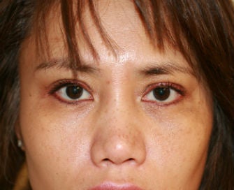 Upper eyelid blepharoplasty after 269086