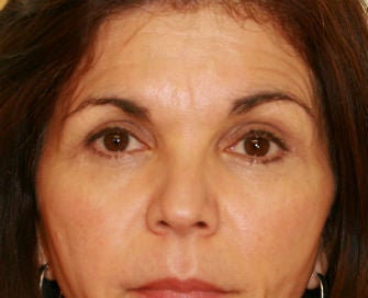 Lower eyelid blepharoplasty after 378926