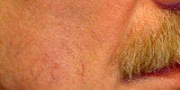 Sculptra after 272058