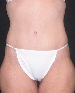 Tummy Tuck with Flank Liposuction after 330911