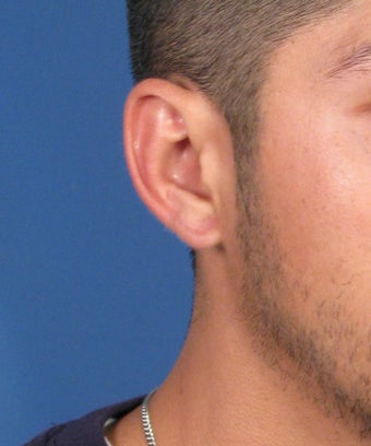 Gauge Earring Repair Otoplasty Surgery after 617423