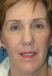 Neck Lift Surgery after 324030