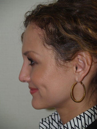 Revision Rhinoplasty 330464