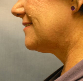 chin liposuction after 408393