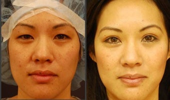 Asian Eyelid Surgery - Double Eyelid Surgery before 564019