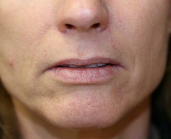 Lip lift before 605281