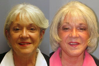 Lite Lift, Liposuction of the neck, Brow Lift, Blue Peel after 523496