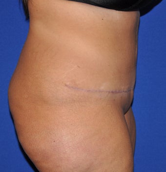 Abdominal Panniculectomy 582153