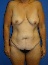 Breast Lift with Implants, Extended Tummy Tuck, before 399479