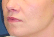 Lift Lip after 635458