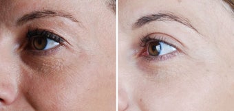 Cosmetic eyelid surgery before 128410