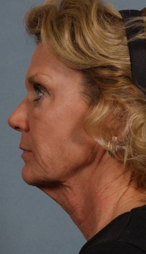 FaceLift before 269513
