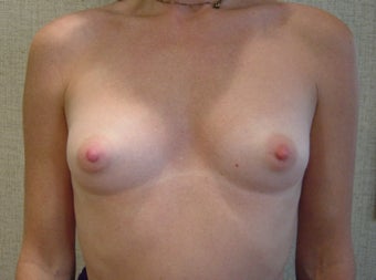 Breast Augmentation before 346178
