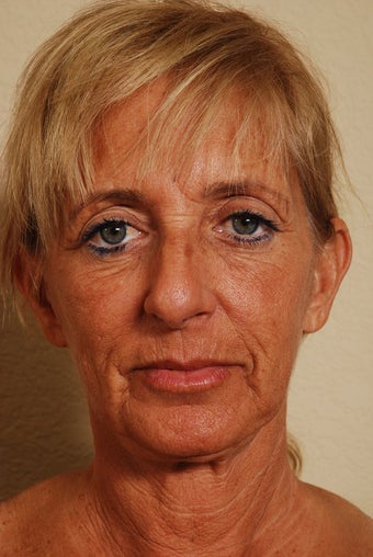 Stem Cell Enriched Facial Rejuvenation before 173285
