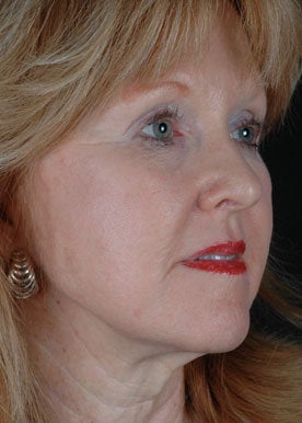 CO2 Laser Resurfacing after 368979