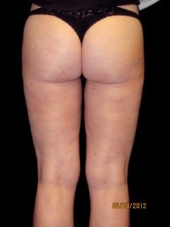 Cellulaze 614469