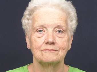 Facial rejuvenation before 140822