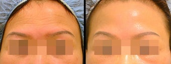 Endoscopic Brow Lift before 649392