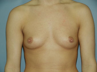 Breast Augmentation before 512169