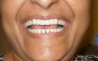 Cosmetic Dentistry Fixed Prosthesis after 254543