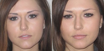 Non Surgical Lip Enhancement before 549889