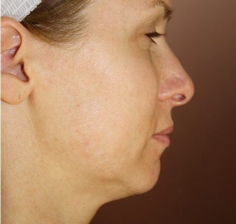 Neck Lift and Upper Eyelid Blepharoplasty before 406795