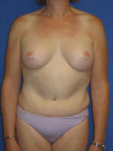 Male breast augmentation and tummy tuck after 106845