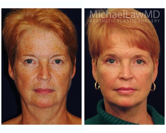 Facial Rejuvenation before 395152