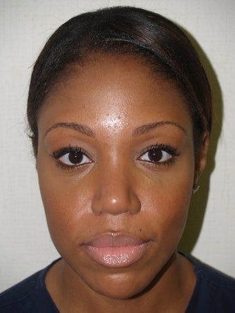 Primary rhinoplasty after 172862
