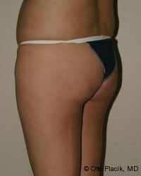 Buttock Augmentation 566730