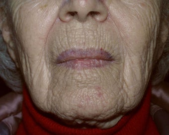 Deep chemical peel of the perioral region before 225273