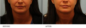 Juvederm before 458716