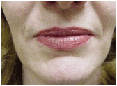 restylane before 267544