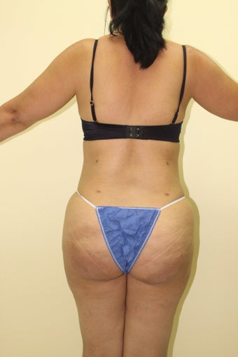 Brazilian butt lift after 360221