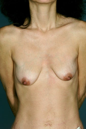 Tear Drop Augmentation Mastopexy before 234781